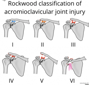 Rockwood classification of AC joint injury